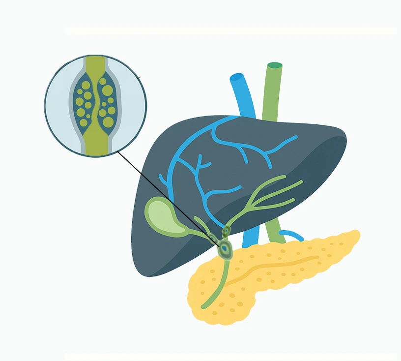 Cáncer de vías biliares